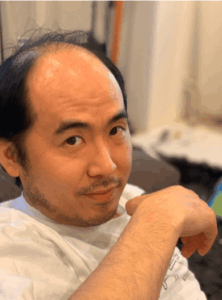 M字はげ芸能人を一挙紹介！一般男性の差が分かる実用ガイド付き